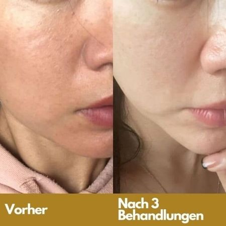 Mesotherapie in Zürich