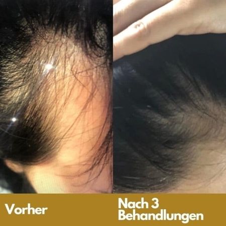 Mesotherapie in Zürich
