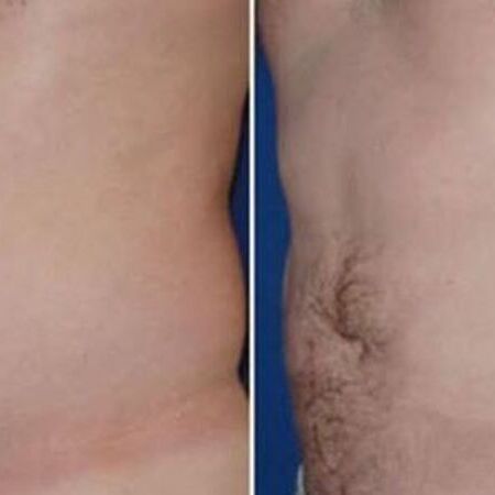 EM-Slim Behandlung mit Magnetwellen zum Traumfigur bei Swisskin Clinic AG