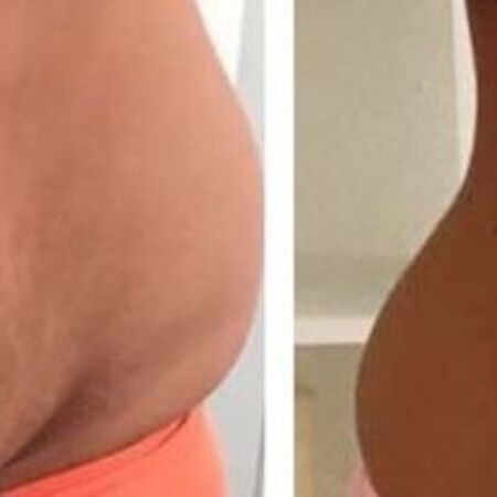 EM-Slim Behandlung mit Magnetwellen zum Traumfigur bei Swisskin Clinic AG