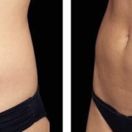 EM-Slim Behandlung mit Magnetwellen zum Traumfigur bei Swisskin Clinic AG