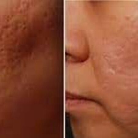 Microneedling-Behandlung bei Swisskin Clinic AG