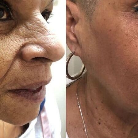 Microneedling-Behandlung bei Swisskin Clinic AG