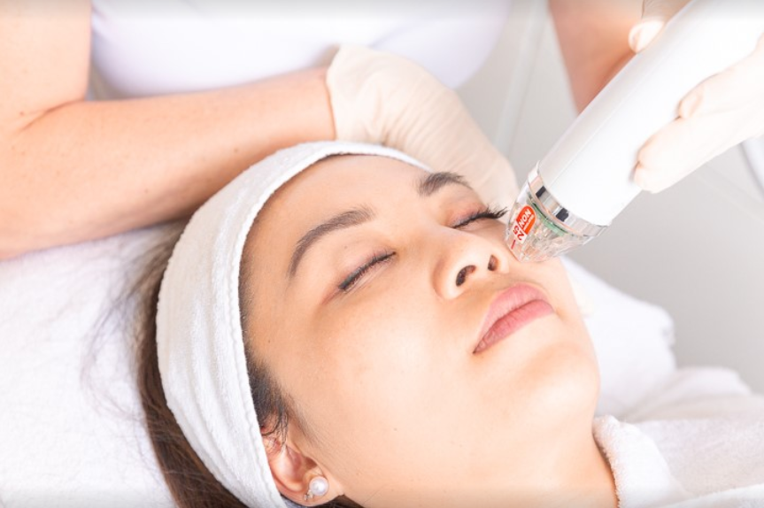 Radiofrequenz Microneedling