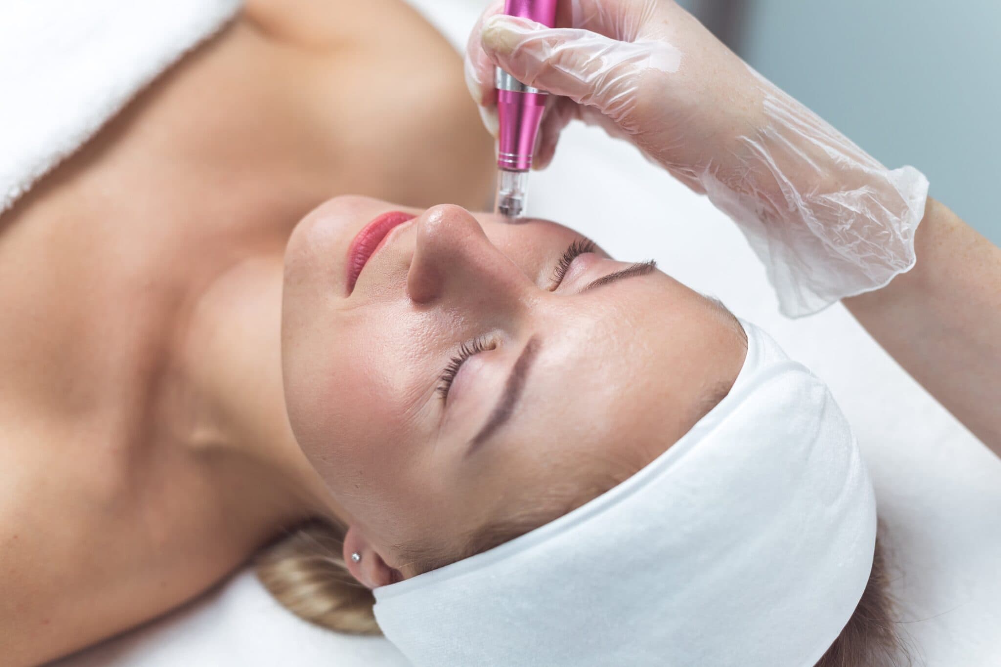 Aknenarbenbehandlung mit Microneedling in Zürich